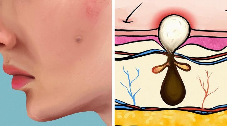 Pustules (Pimples)